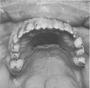 3 Acrylic core fusing tripod implant pin prepared as posterior abutment