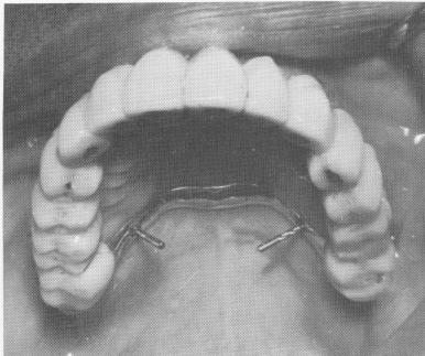 1 Tripod pin implant through palatal bar in bone to save prosthesis