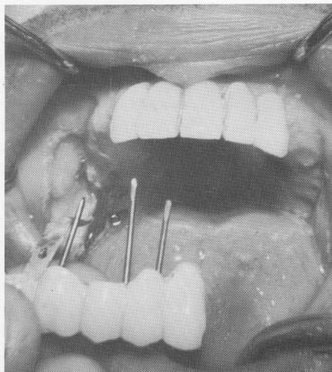 2 Tripod implant pins bent flush with palatal bar, sealed with acrylic