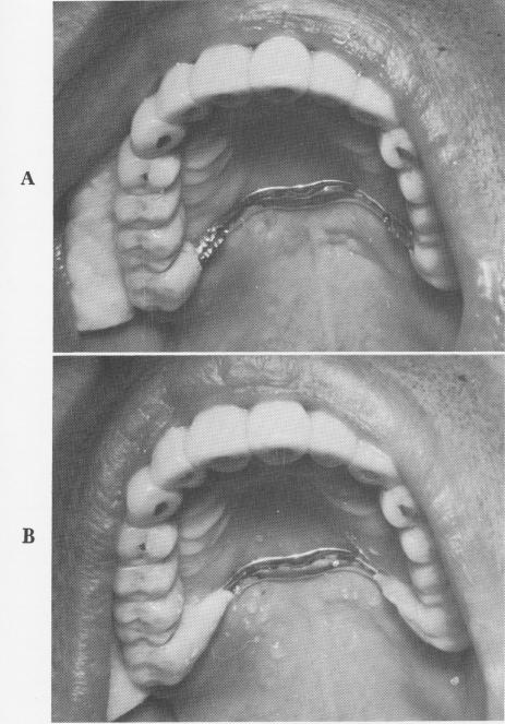 3 Posterior quadrants removed, tripod pin implants locked to prosthesis