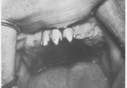 4 Endosseous vent-plant implant unit is firm in the bone