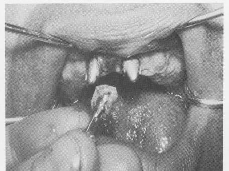 5 Unit severed, nasal septum vent-plant implant removed