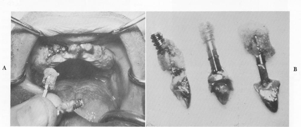 1 Vent-plant implant in upper lateral incisor regions held by bone