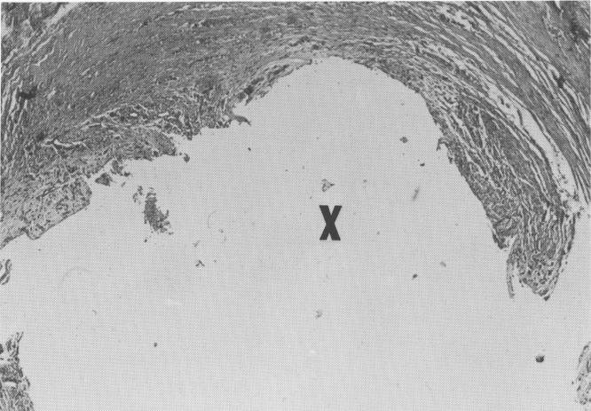 2 Removal of endosseous vent plant implants from nasal septum and bone