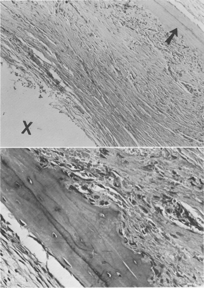 1 Pseudoperiodontal membrane and osteogenesis near vent plant implant