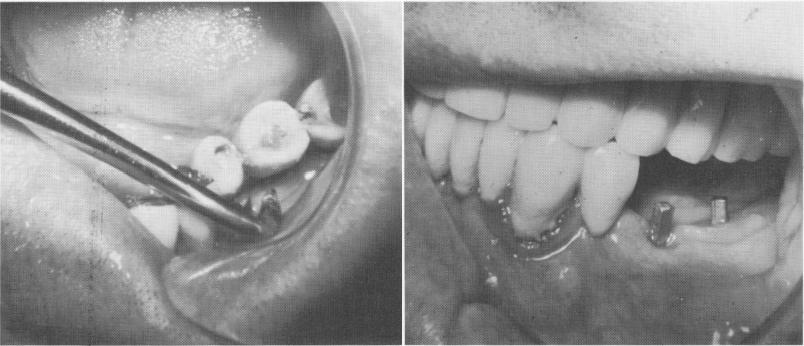 1 View of vent plant endosseous implant posts in mandible