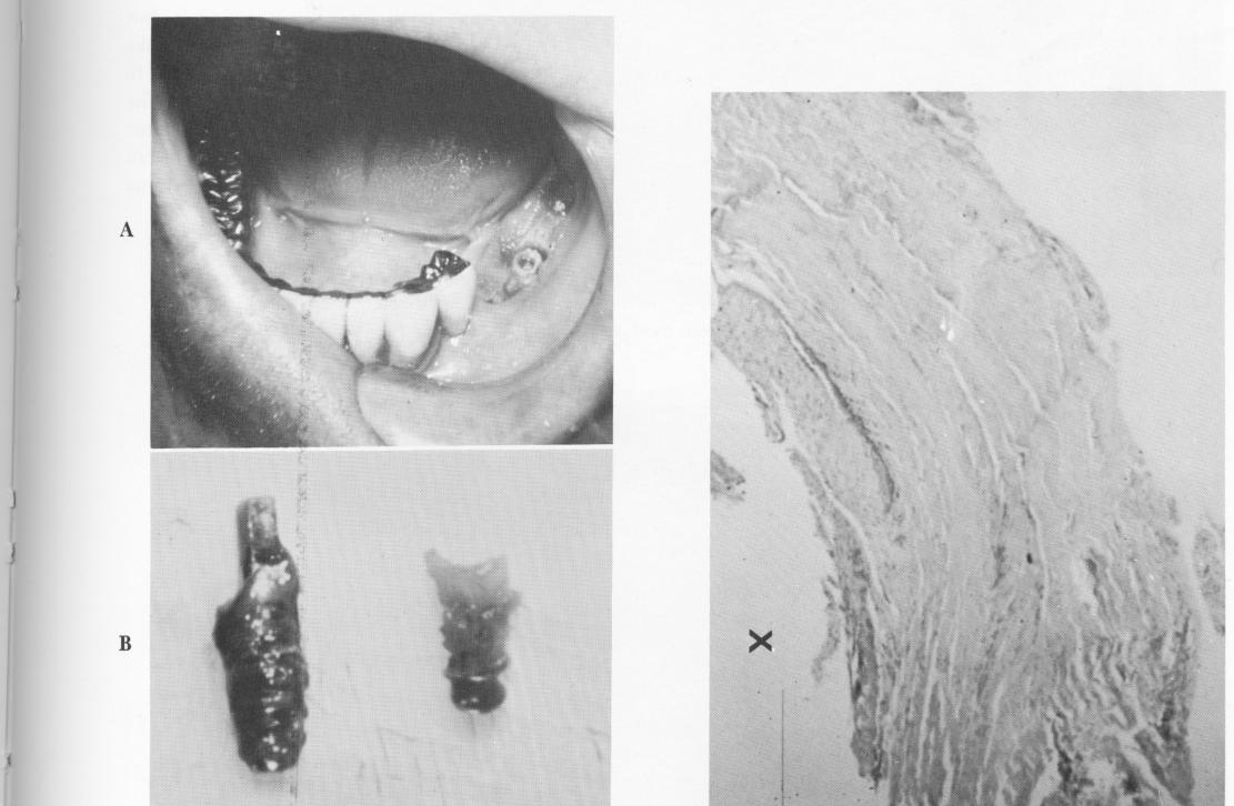2 Circular core of bone drilled to remove posterior vent plant implants 