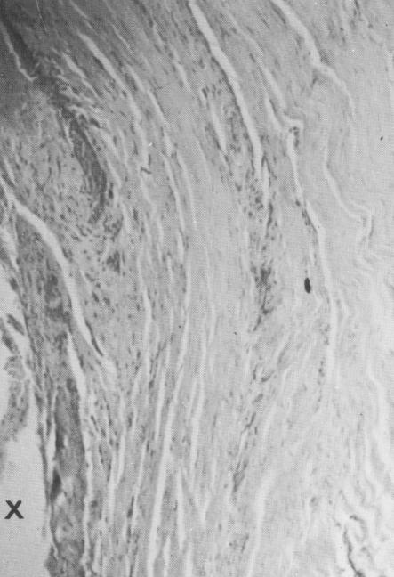 1 Histology of soft tissue near vent plant implant site show fibroblasts