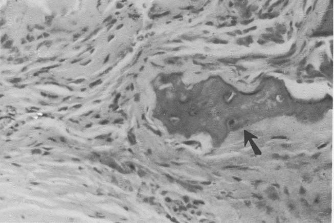 2 Vent plant implant site shows calcified tissue at soft tissue periphery