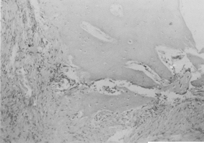 2 Histology of vent plan implant site shows bone fragment with osteocyte