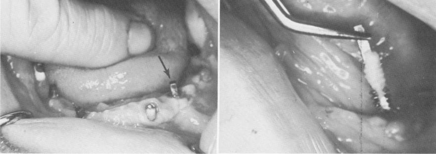 1 Vent plant implant exposed in mandible after removal of prosthesis