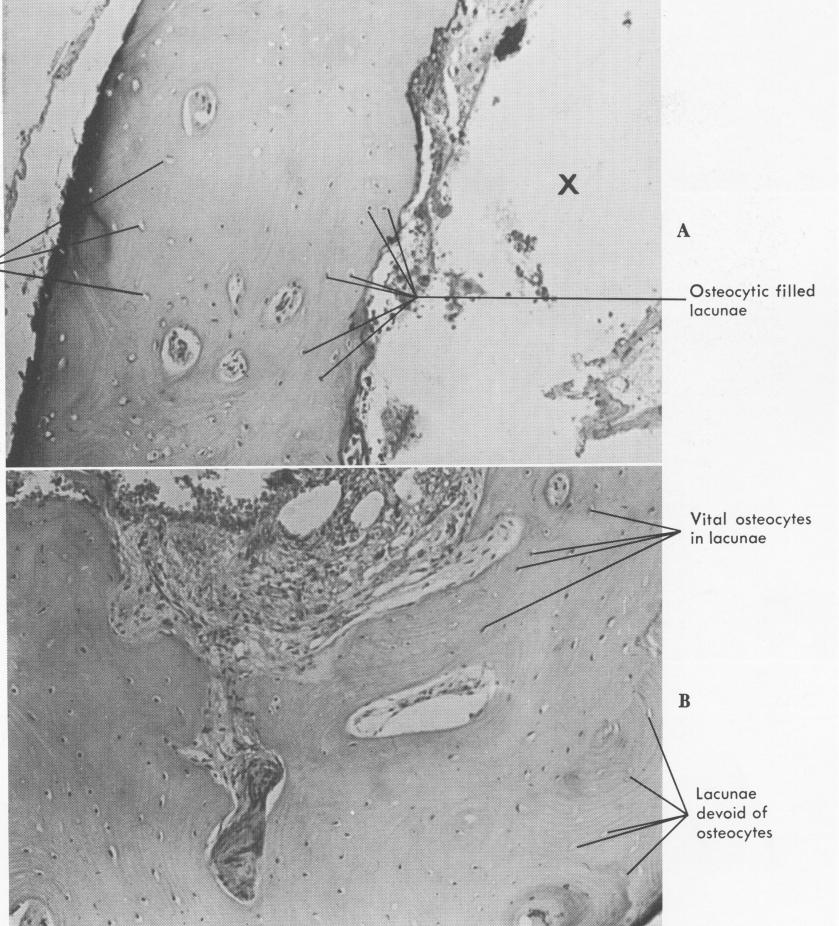 1 Non vital bone tissue near vent plant implant site with empty lacunae