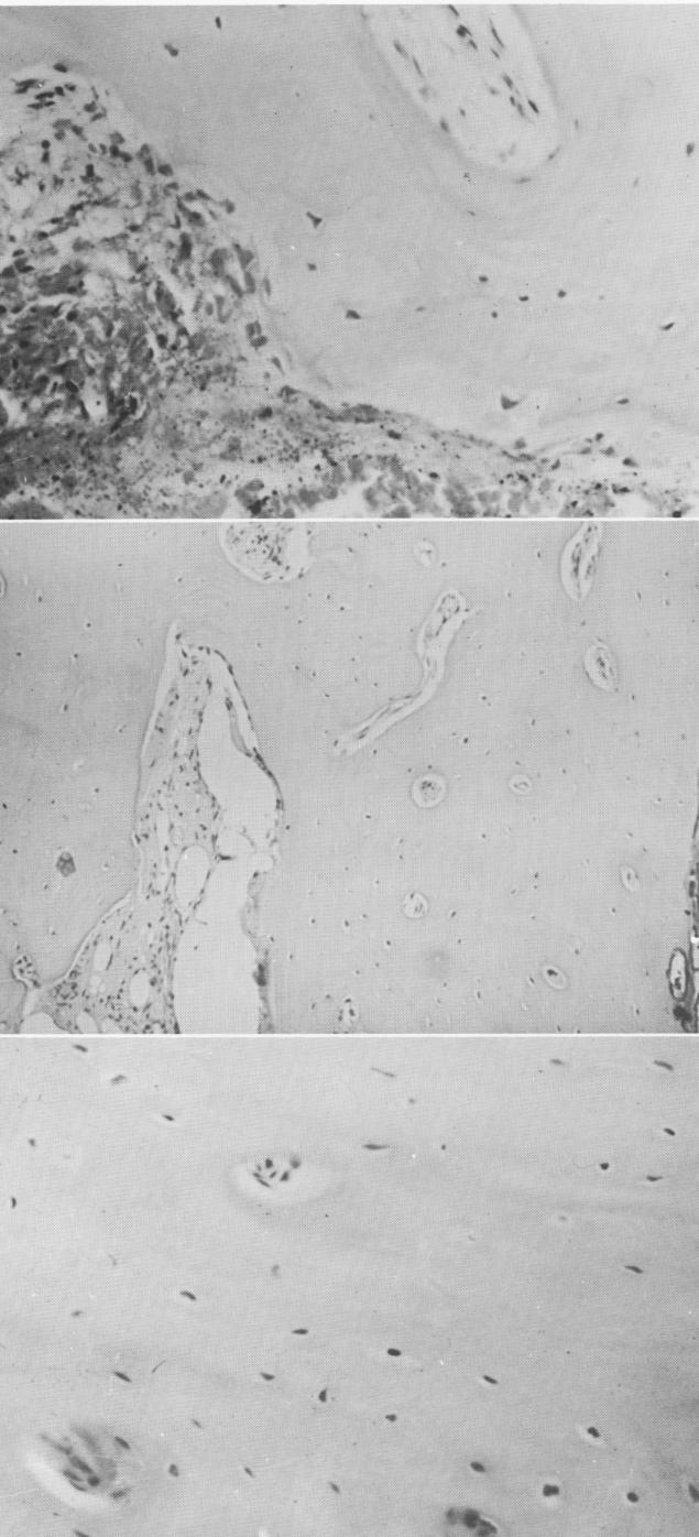 1  Surgical hemorrhage in bone section near vent plant implant site