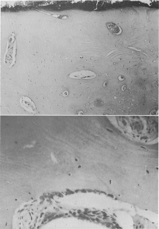 1 Outer surface of bone devoid of osteocyte at vent plant implant site