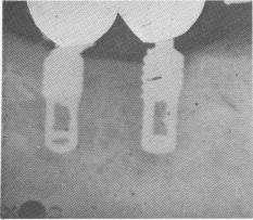 2 Proximity of vent plant implant to inferior alveolar canal in mandible