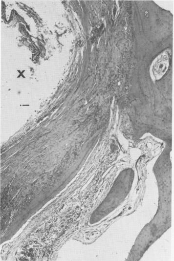1 Vent plant endosseous implant contains bone in its vent portion 