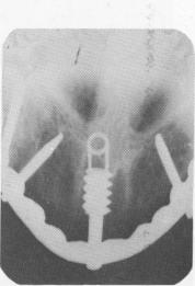 3 Dense bone with numerous osteocytes around vent plant implant site