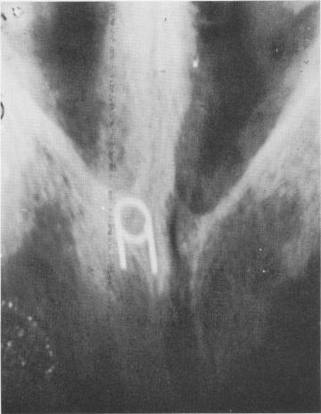 1 Shaft portion of vent plant implant removed, vent portion in mandible