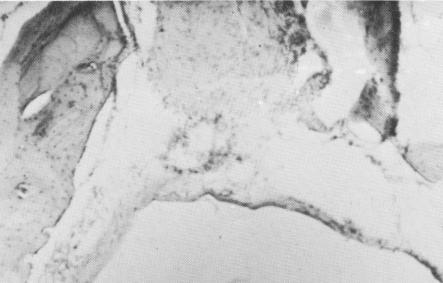 2 Surgically removed apical ring, rest of vent plant implant in mandible