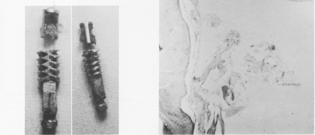 3 Bone block shows dense bone separated from vent plant implant site