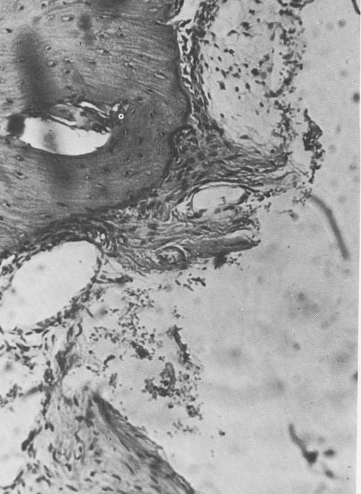 1 Bone tissue around implant with osteocytes and osteoblastic activity