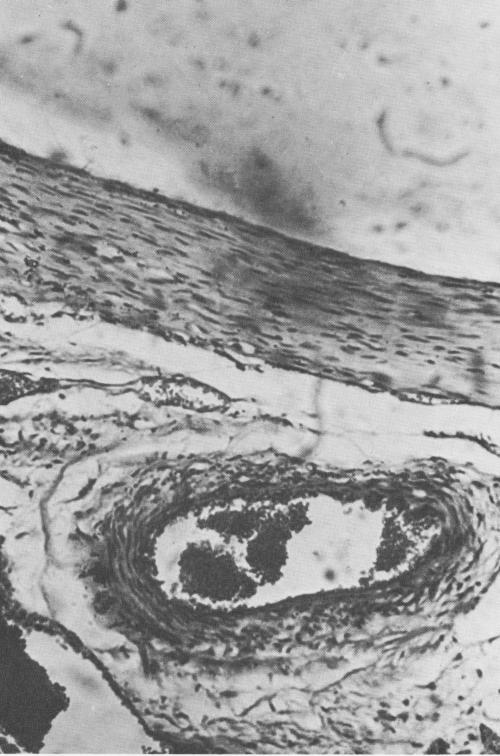 1 Blood vessel formation appears near the base of endosseous implant