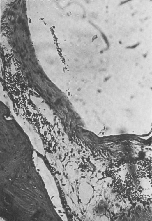 2 Highly organized connective tissue near base of endosseous implant