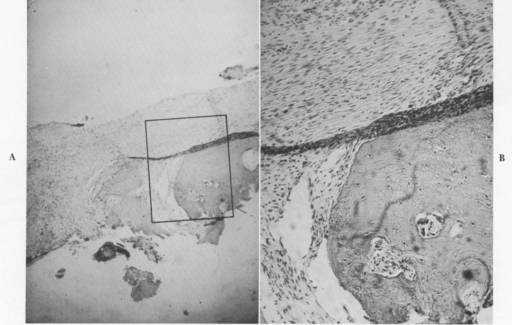 1 Fibrous tissue and bone are seen in vent of vent plant implant