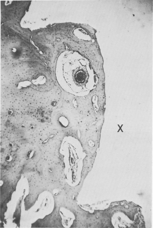 1 Bone section around a crystalline endosseous implant site 