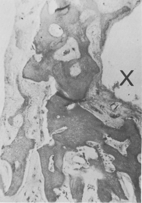 1 Bony bridge covered by fibrous tissue at crystalline implant site