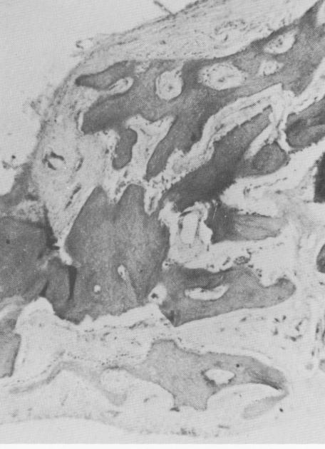 2 Healthy bony bridge tissues around crystalline implant