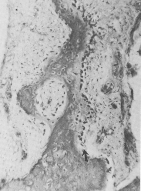 1 Osteoblasts in line of endosseous crystalline implant bridge