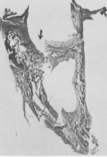 2 Inflammation of bone tissue when crystalline implant at alveolar crest