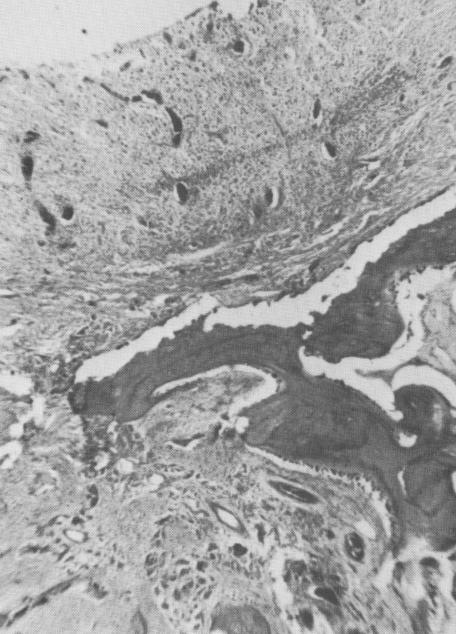 1 Inflammation and breakdown of bone tissue at crystalline implant site