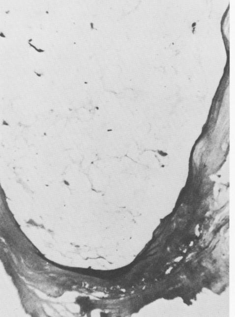 2 Extensions of connective tissue into endosseous crystalline implant 