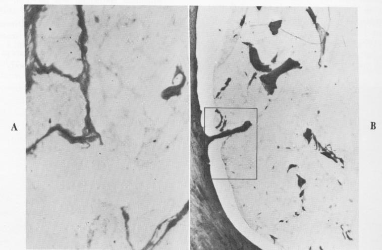 1 Fibrous strand extension into endosseous blade implant in mandible