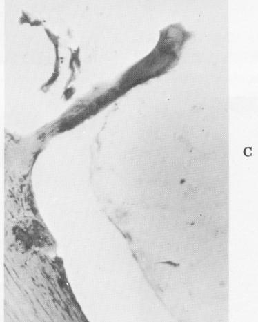 2 Histology shows fibrous extension into lower endosseous blade implant
