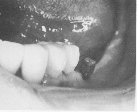 1 Healthy soft tissues around an endosseous blade implant in mandible