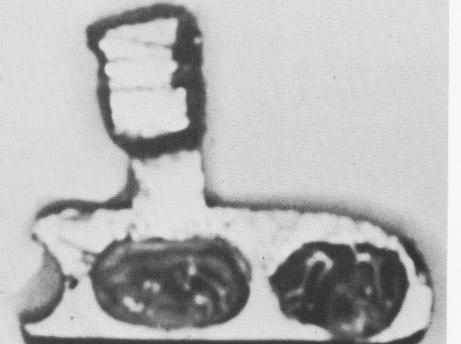 2 Incisions made to free affixed endosseous blade implant in mandible