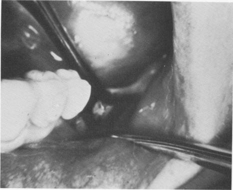 3 Clinical view of blade implant with mandibular bone in its vents
