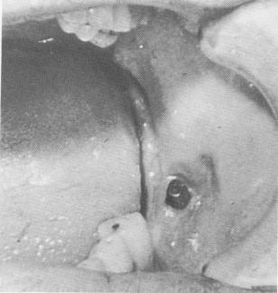 4 Buccally protruding post of endosseous blade implant in mandible