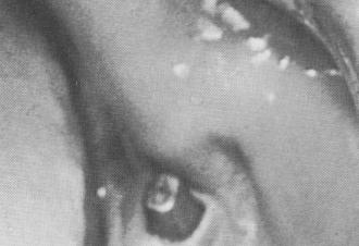 1 Inside of cheek follows lower endosseous blade implant post outline