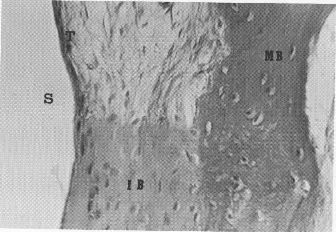 2 Bone separated from subperiosteal implant site by connective tissue 