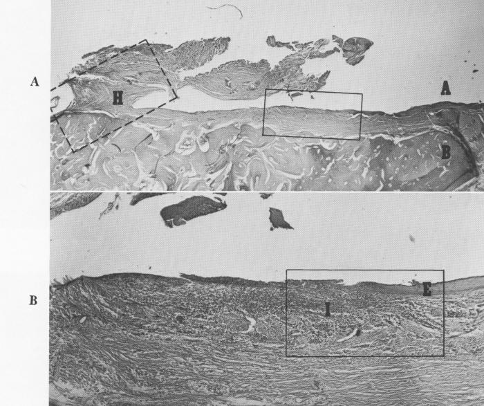 1 Thick soft tissue between subperiosteal implant abutment site and bone