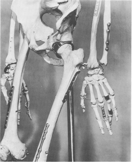 1 Metallic prosthetic implantations for fixing fractures, replacing bone