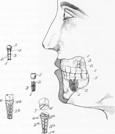 1 Greenfield`s endosseous implant patent gives space for tissue growth
