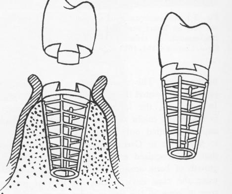 2 Greenfield`s endosseous post type implant is widest at alveolar crest