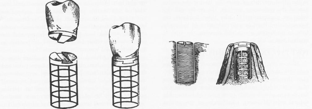 1 Modified Greenfield`s endosseous implant with bone core left at site