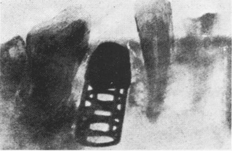 2 Xray of Greenfield modified endosseous implant`s fit on intact bone core