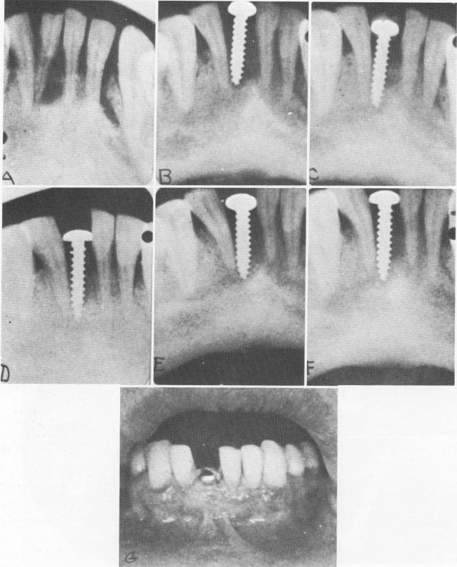 1 Xray of tooth to be extracted at Strock`s endosseous implant site